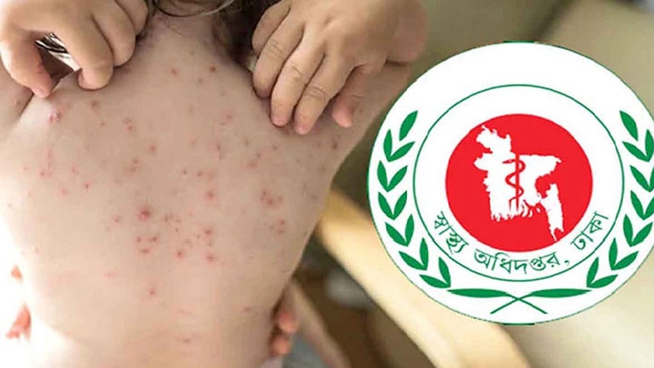 হাম উপসর্গে আরও ৩ শিশুর মৃত্যু, আক্রান্ত হাজারের বেশি