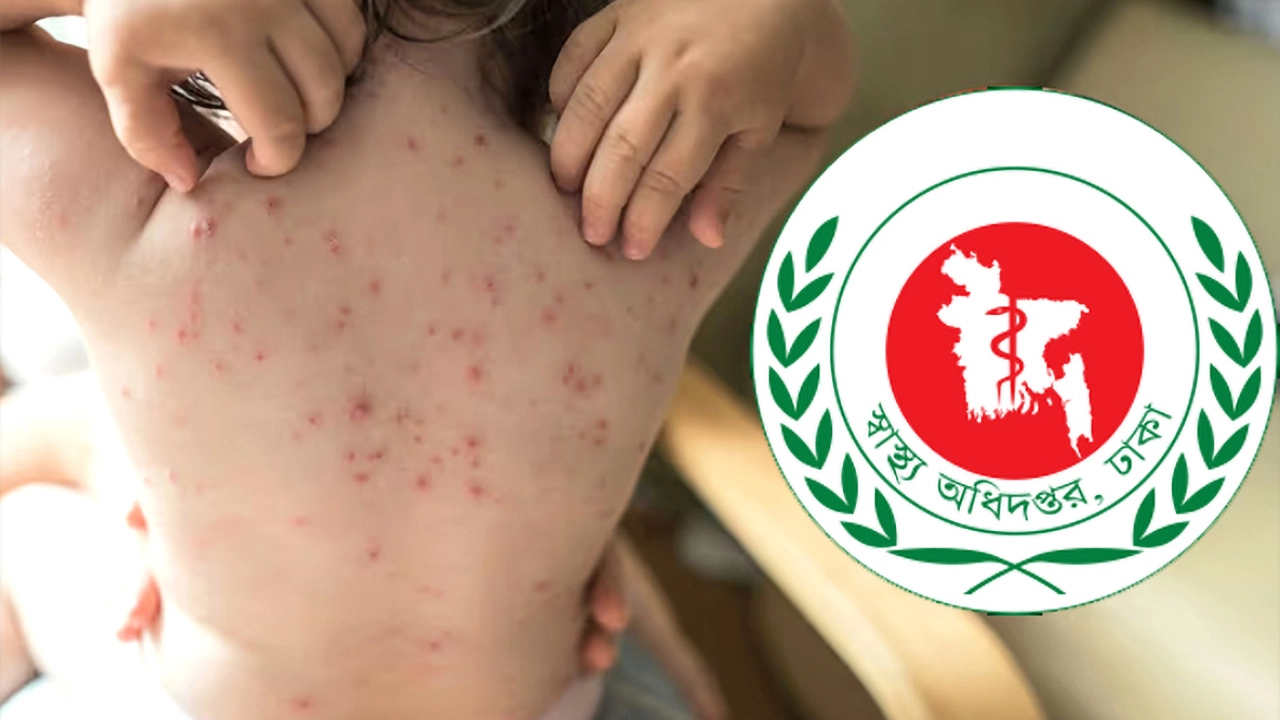 হামের উপসর্গে ৬ শিশুর মৃত্যু